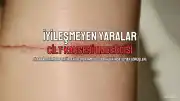 Cilt Kanseri Riski: İyileşmeyen Yaralar ve Güneş Maruziyeti Uyarıyor