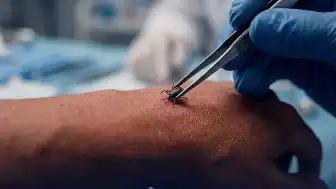 Uzman Doktordan Kene Isırıklarına Karşı Üç Kritik Uyarı